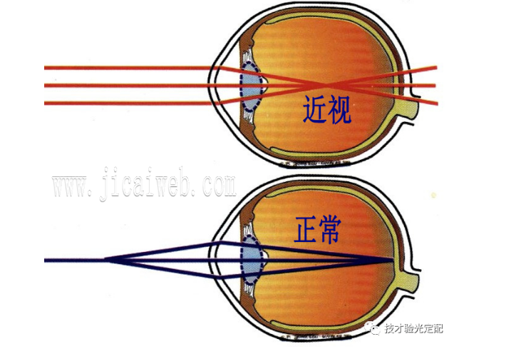 远处的平行光线所形成的焦点不位于视网膜上,位于视网膜前,则称为近视